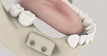 animation 3D sur la thématique de la greffe osseuse et le comblement osseux en dentisterie