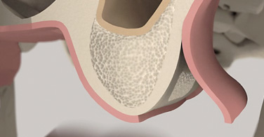 animation 3D sur le comblement de sinus maxillaire par voie latérale