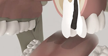 animation 3D sur la résection apicale associée à un traitement endodontique orthograde