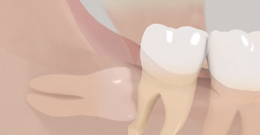 animation 3D sur la dent de sagesse mandibulaire horizontale et son traitement