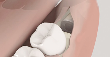 animation 3D sur l'extraction dent de sagesse mandibulaire horizontale