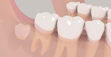 animation 3D sur le traitement des dents de sagesse complètement incluses
