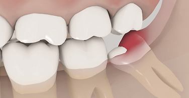 animation 3D sur le traitement des dents de sagesse partiellement incluses