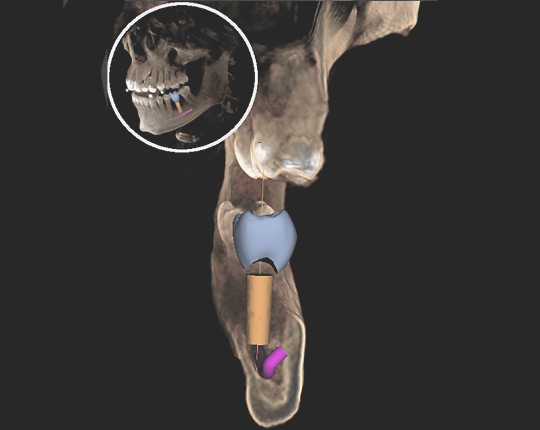 scan de la cavité d'un dent d'un patient avec plannification pour implant